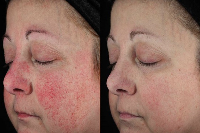 Rosacea копия.jpg